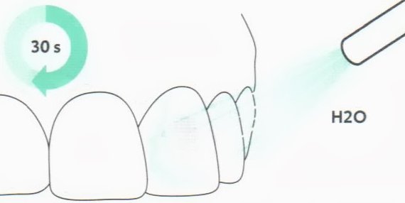 Лечение зубов без сверления ставрополь